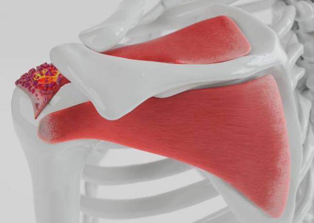 Illustration of calcific tendinitis in shoulder