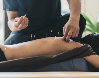 Doctor placing acupuncture needles