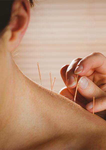 Doctor placing medical acupuncture needles