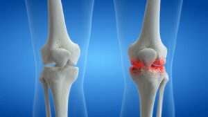 Illustration of arthritic knee joint